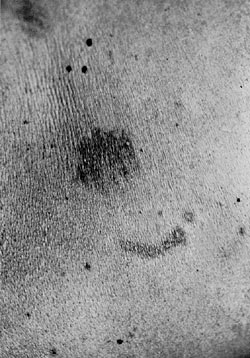 Reflected UV photograph of bite marks